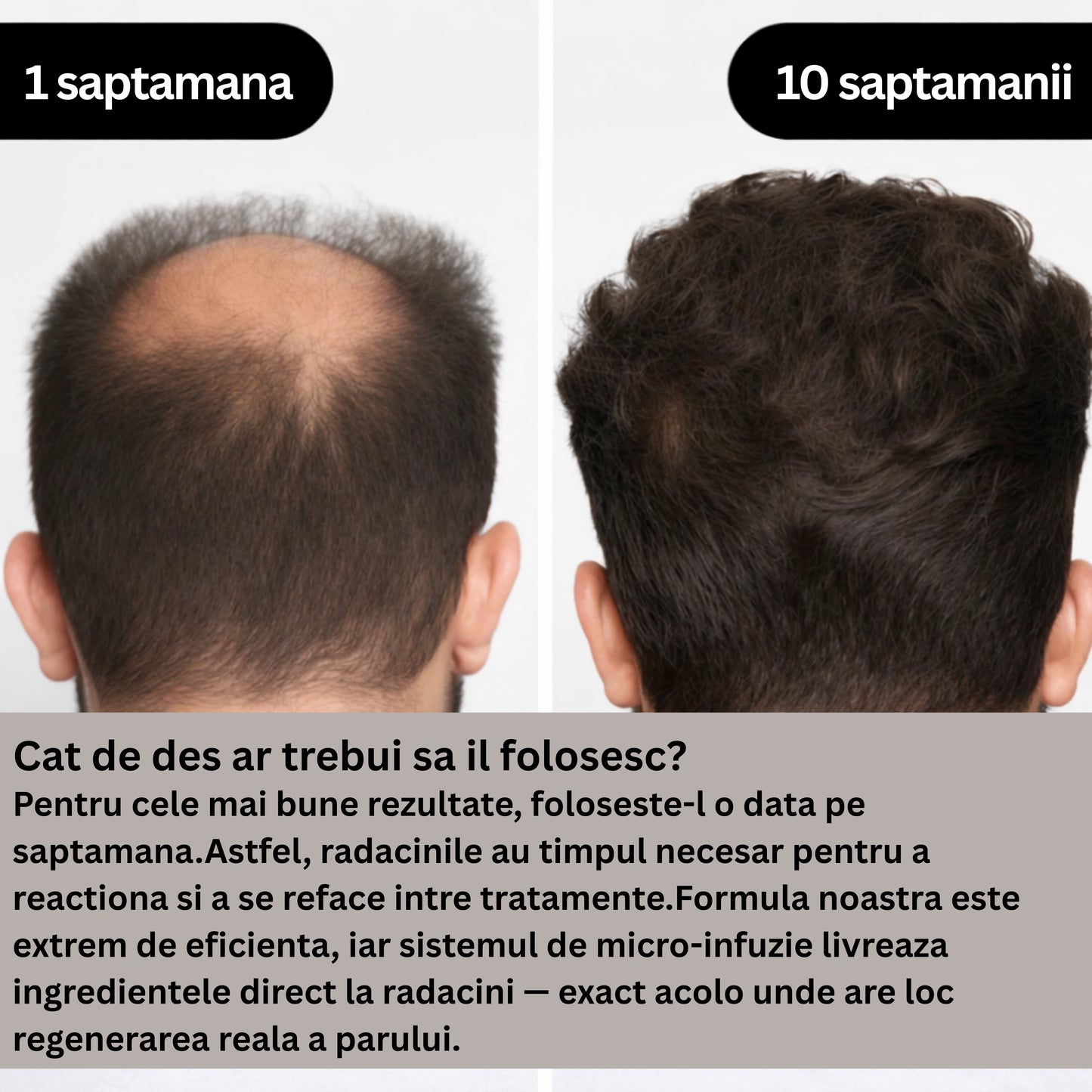 Follicle Alpha™– Sistem de regenerare a părului