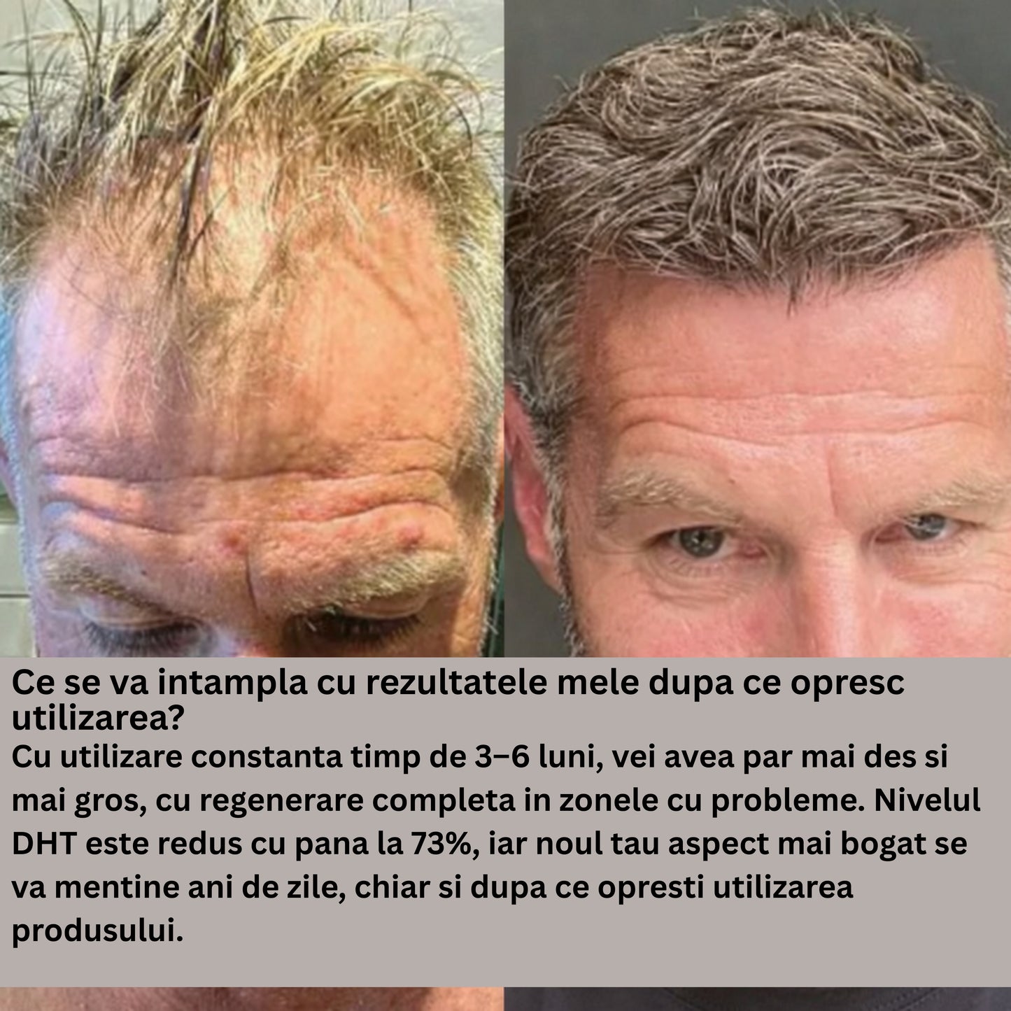 Follicle Alpha™– Sistem de regenerare a părului